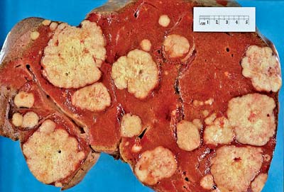 can asacol cause liver damage